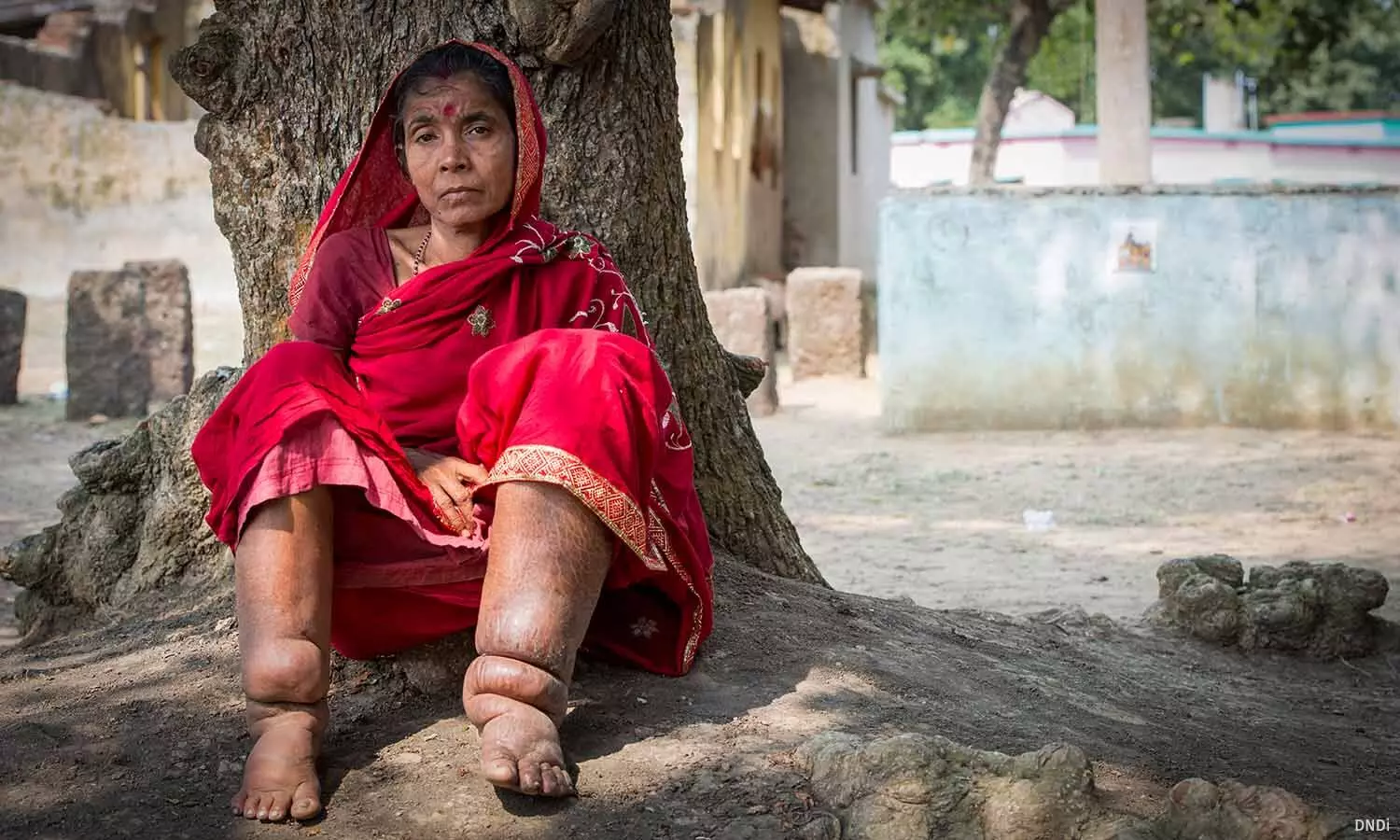 Elimination by 2027? India’s Final Push Against Lymphatic Filariasis